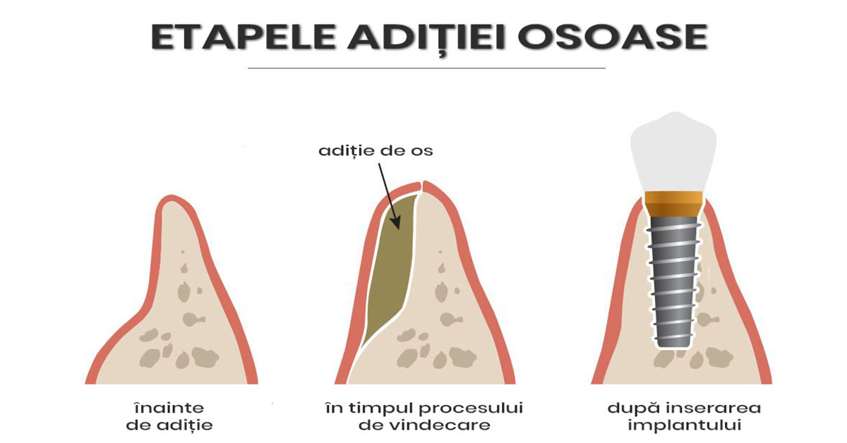 Aditie de Os & Regenerare Ghidata